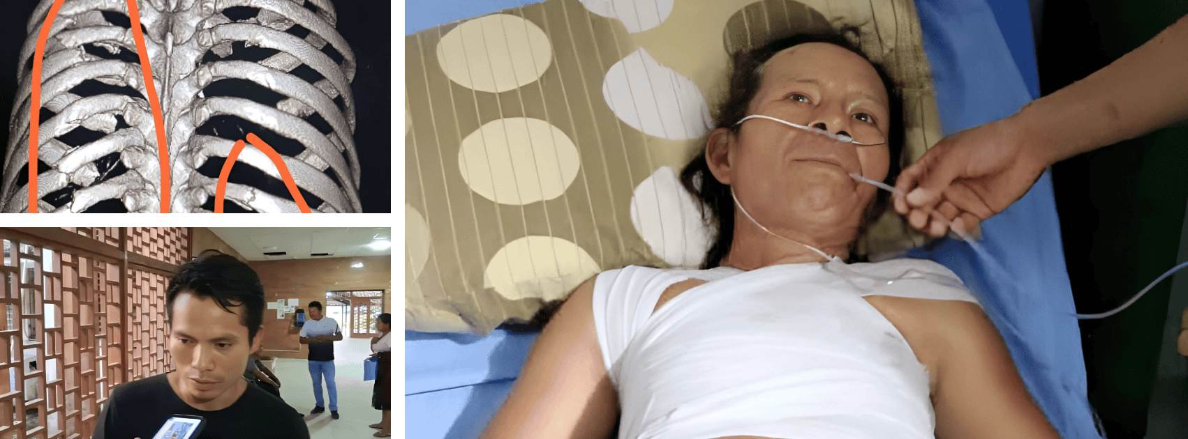 Muerto en hospital de Loreto tras accidente de tránsito, paciente con heridas en el pecho y respirando con ayuda de un tubo de oxígeno.