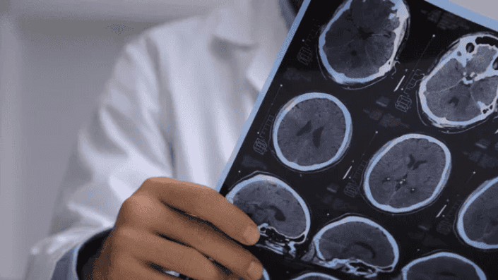 Imágenes de resonancia cerebral en un médico revisando resultados médicos radiológicos de neuroimagen en un hospital peruano.