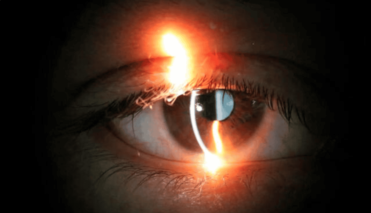 Minería en el ojo con láser en tratamiento oftalmológico, cirugía láser en salud visual, imagen de procedimiento ocular.